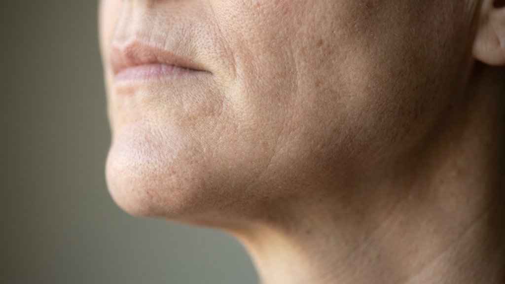 A side-by-side comparison of a patient considering a mini facelift vs deep plane facelift for facial rejuvenation.